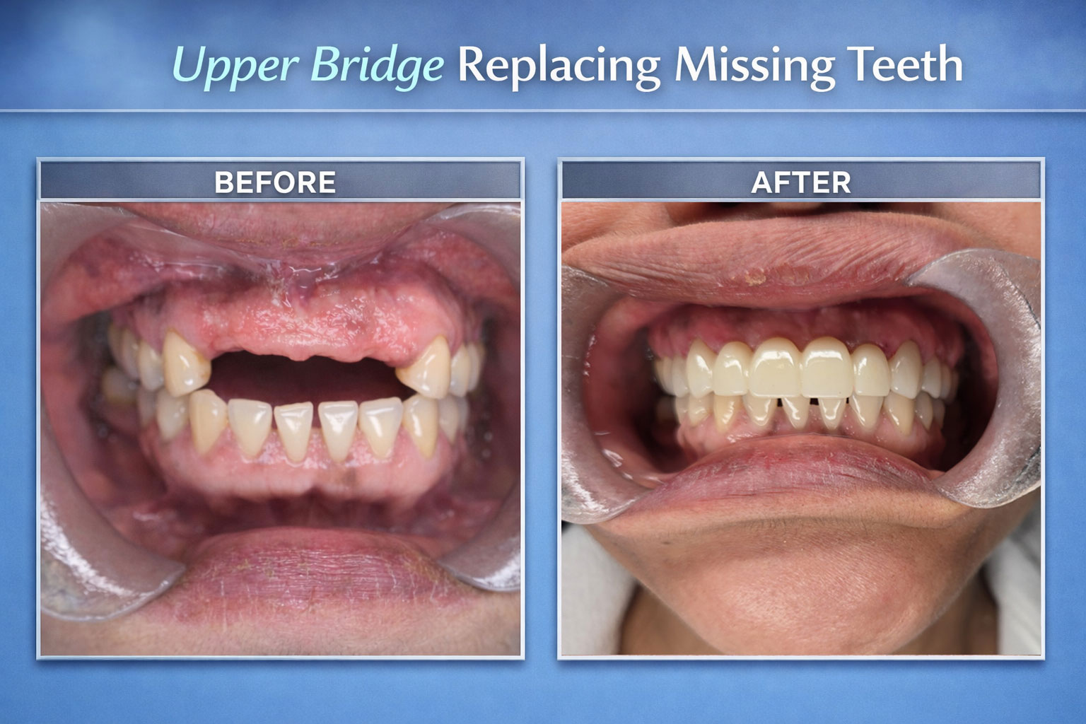 Upper Bridge Replacing Missing Teeth