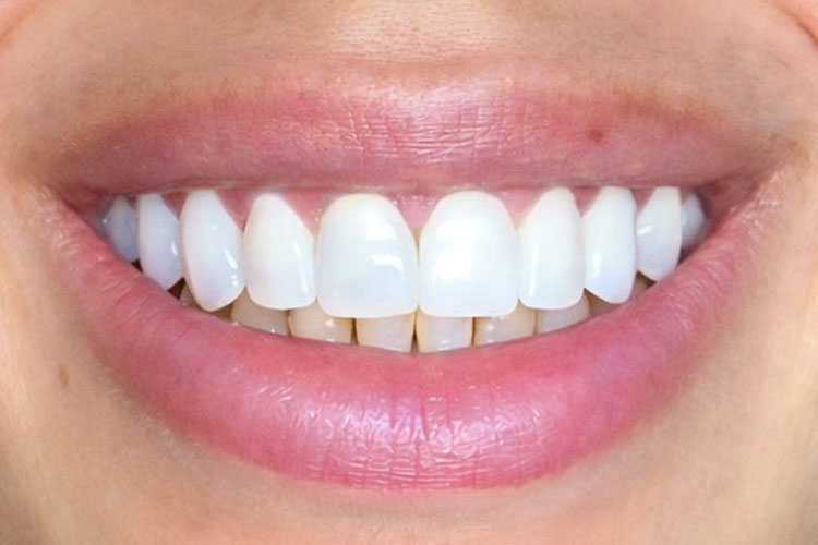 Veneer Makeover (After Image)