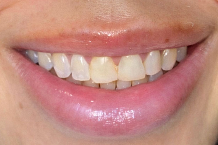 Veneer Makeover (Before Image)