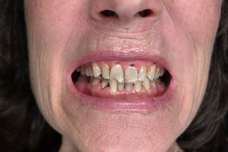 Zirconia Crowns (Before Image)