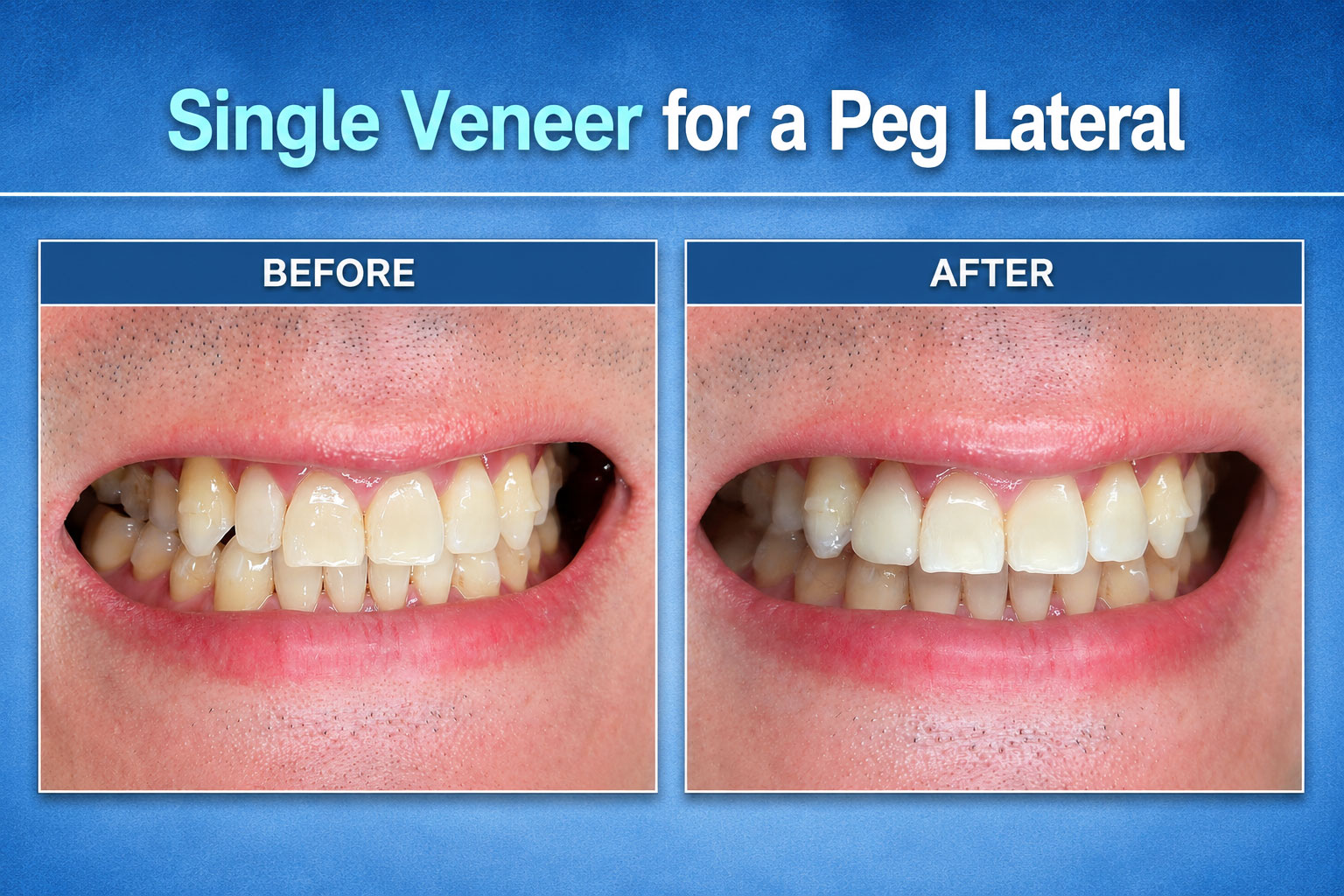 Single Veneer for a Peg Lateral Case - Before After Images
