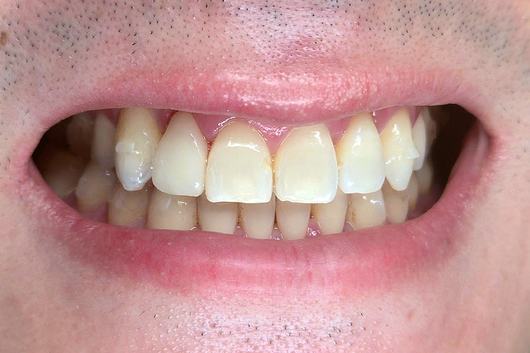 Single Veneer for a Peg Lateral - After Picture