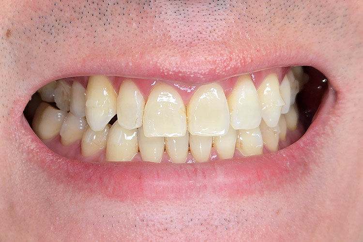 Single Veneer for a Peg Lateral - Before Picture