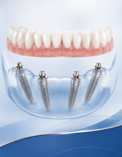 All-On-X Implant Treatment