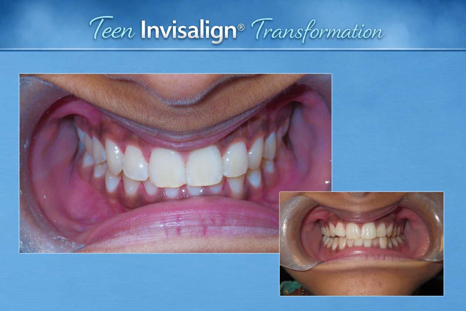 Teen Invisalign Treatment (Before After Image)