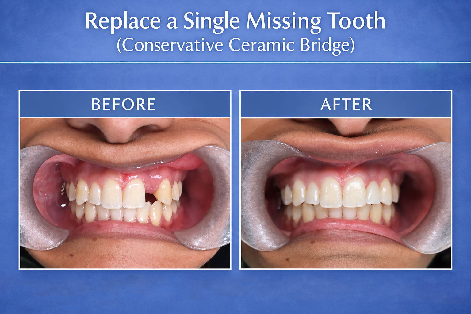 Ceramic Bridge for Single Tooth