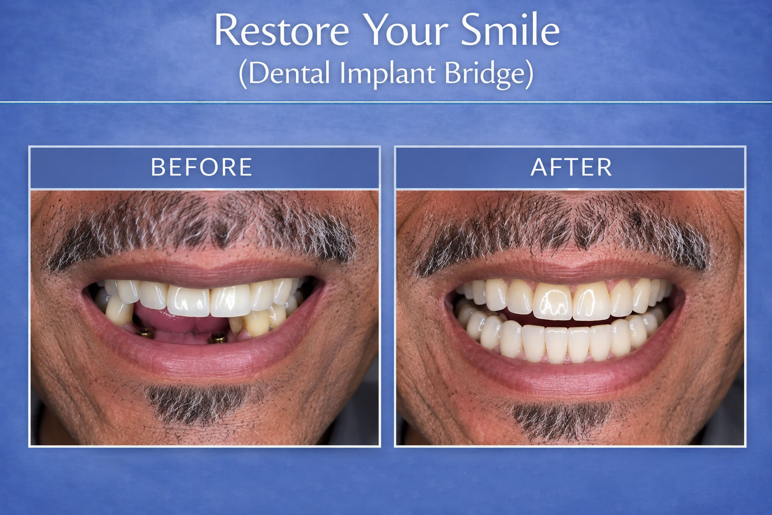 Dental Implant Bridge - Before After Images