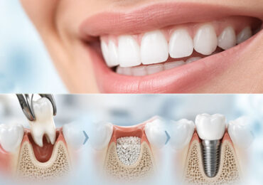 From Tooth Extraction to Dental Implant: Why Preserving the Bone Matters from the Start