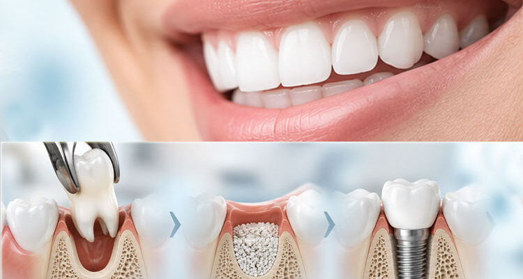From Tooth Extraction to Dental Implant: Why Preserving the Bone Matters from the Start