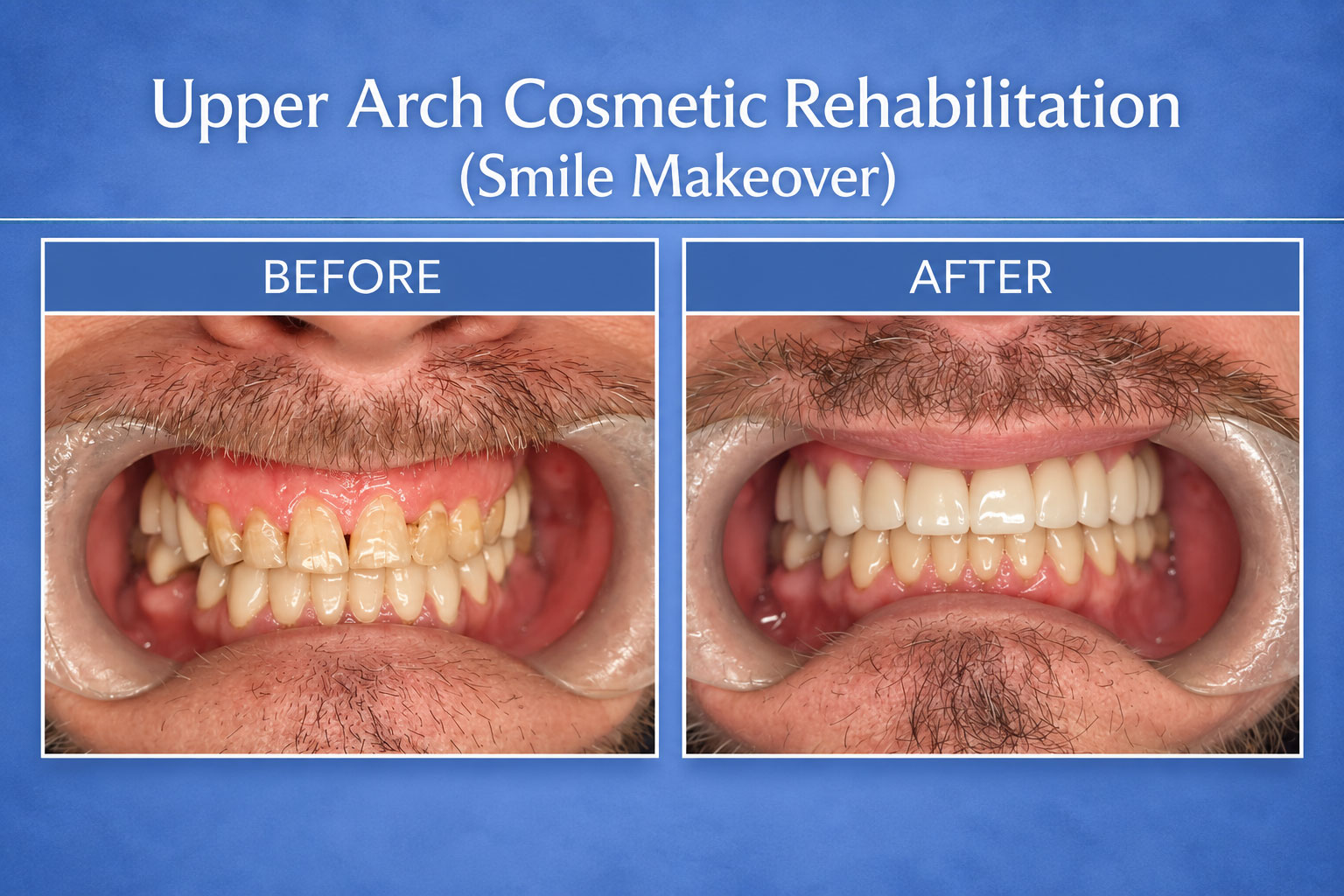 Upper Arch Cosmetic Rehab & Smile Makeover - Before and After Images